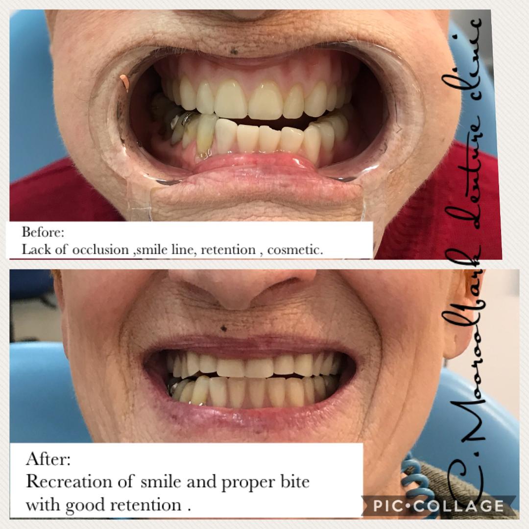 Full upper and Partial lower denture
