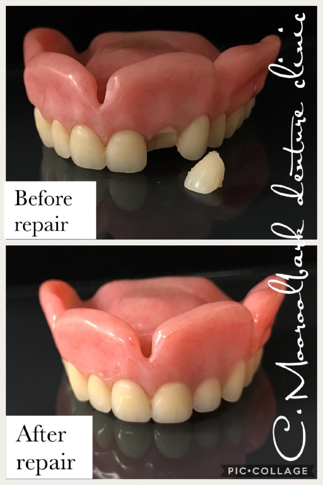 Re-attaching tooth to Full upper denture