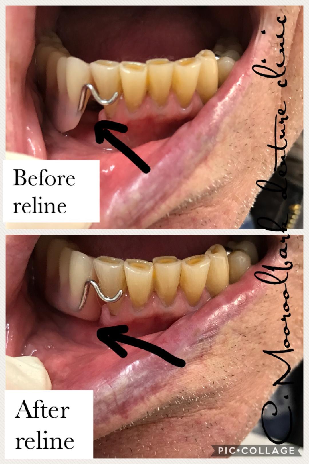 Denture Realignment (Reline)
