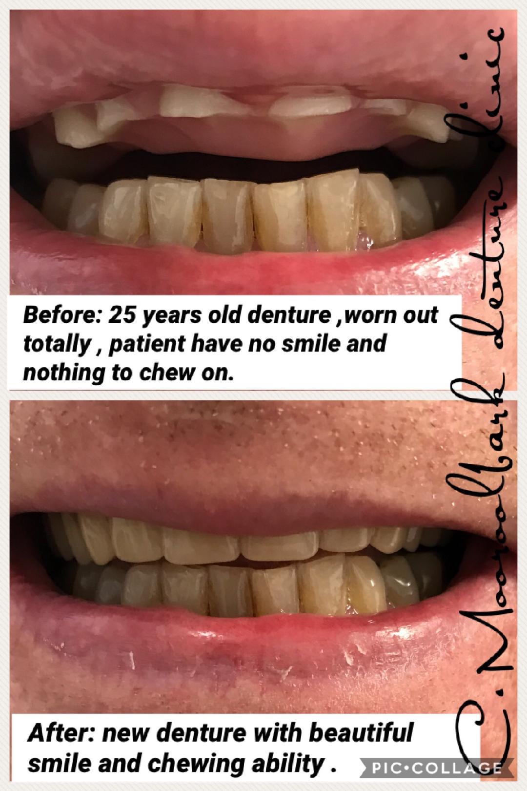 Full upper denture