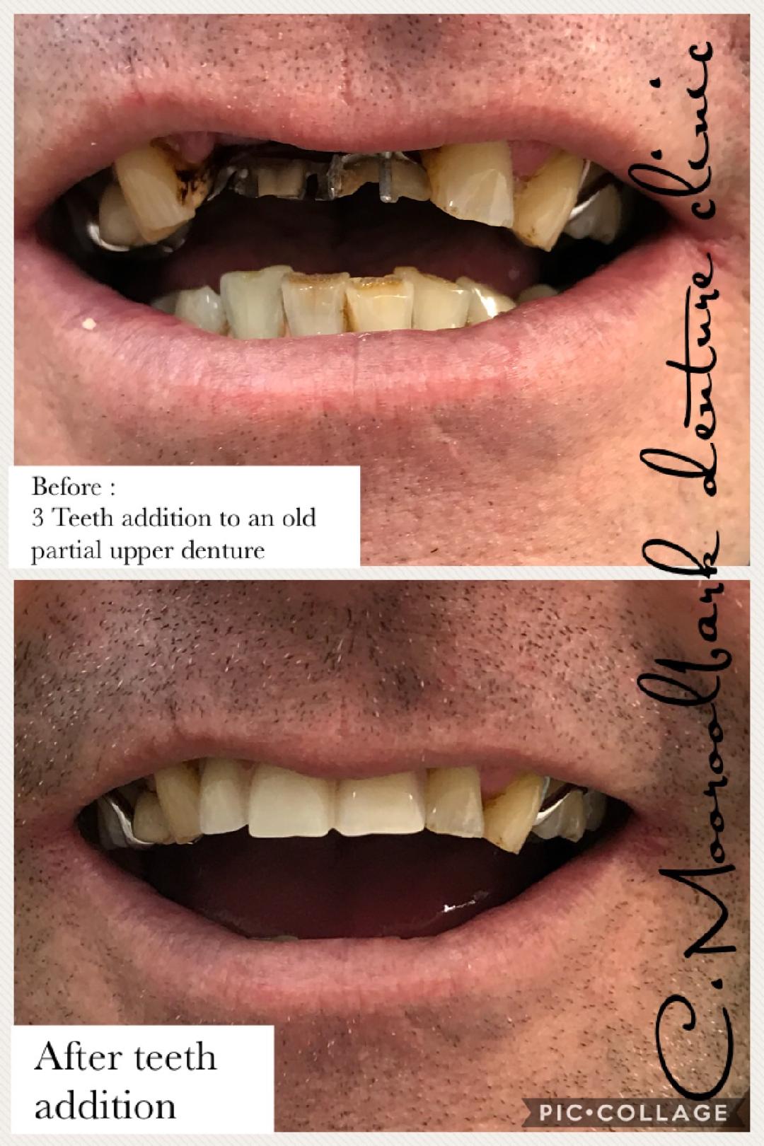 Teeth Addition to Partial Upper denture