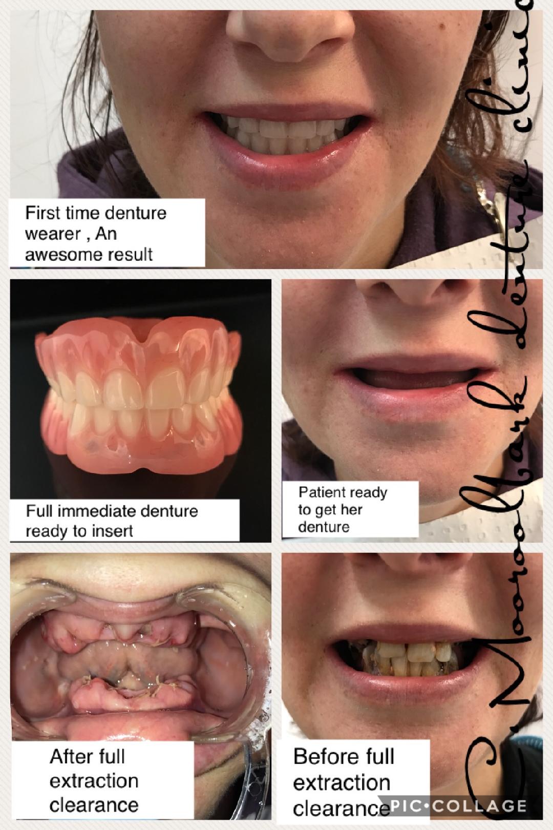Immediate denture