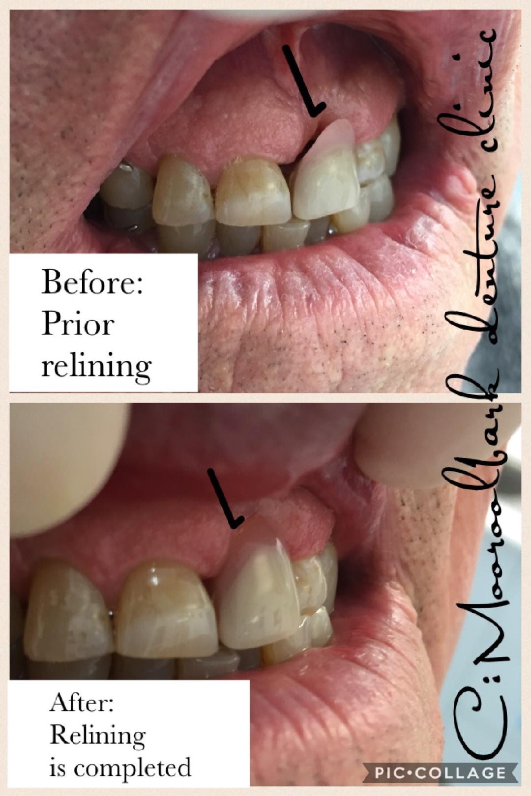 Relining partial denture